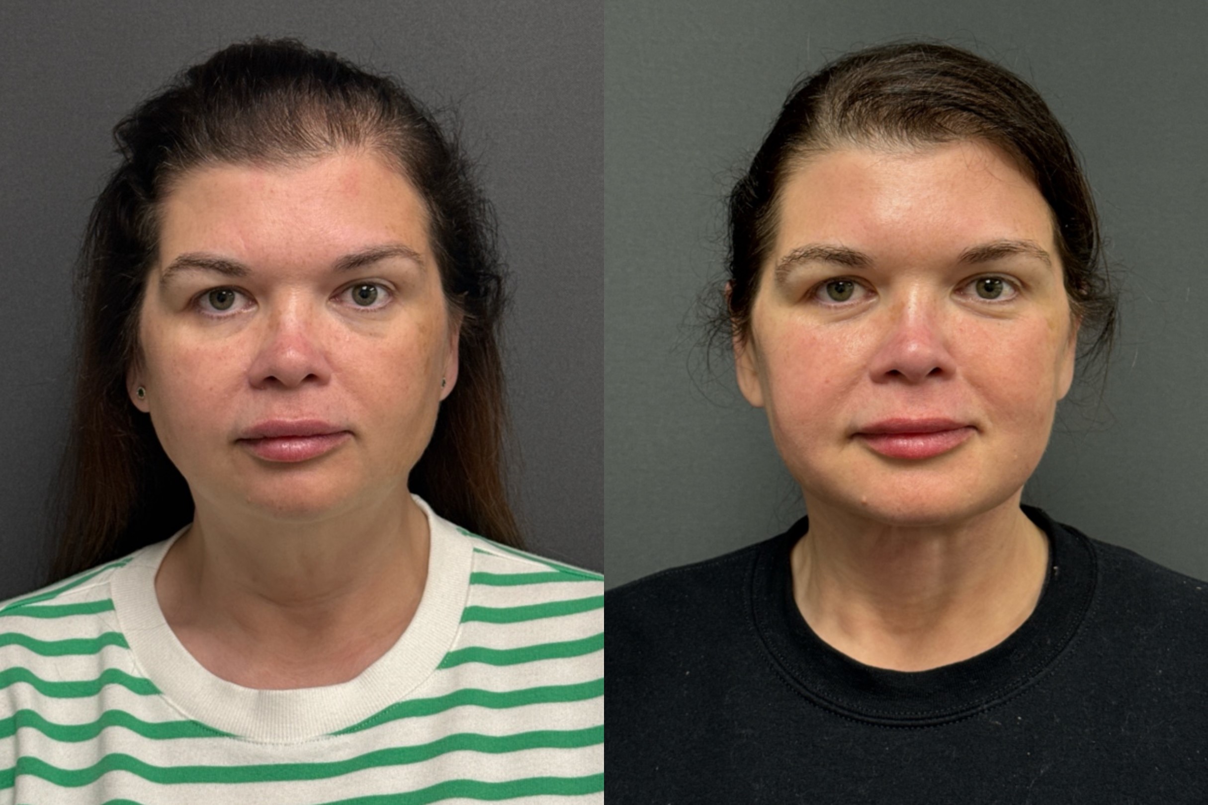 Before and After Image: FACEtite - front