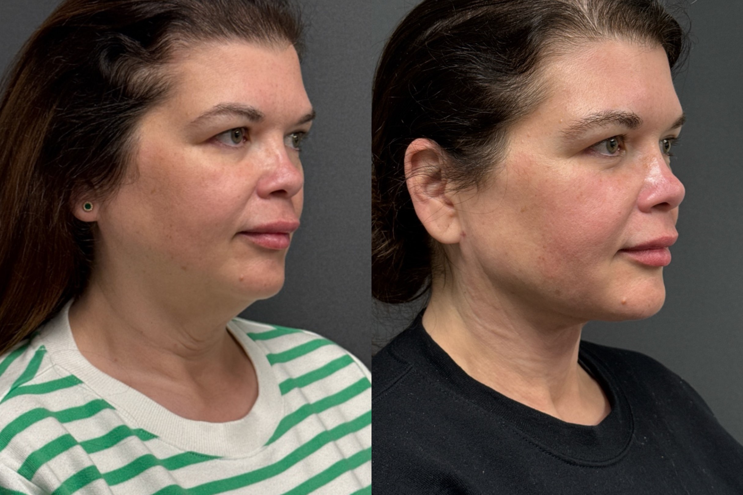 Before and After Image: FACEtite - right-front-oblique