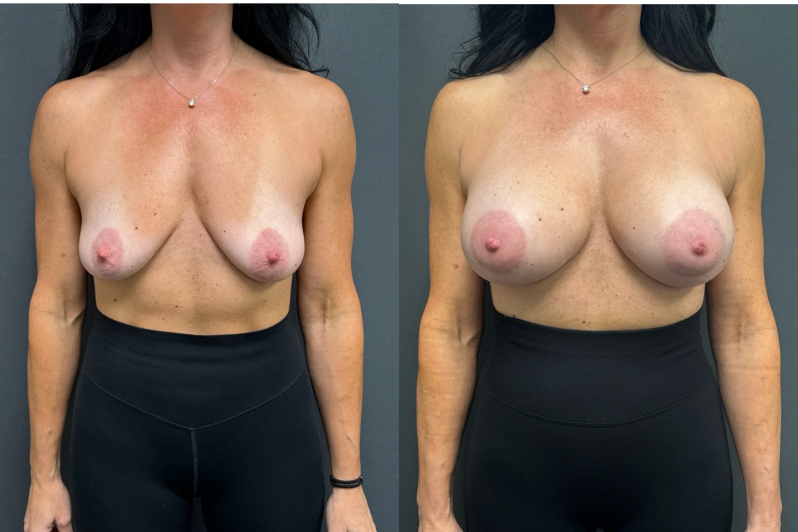 Before and After Image: Breast Augmentation