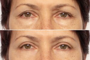 Woman's undereye bags are improved with cosmetic treatments.