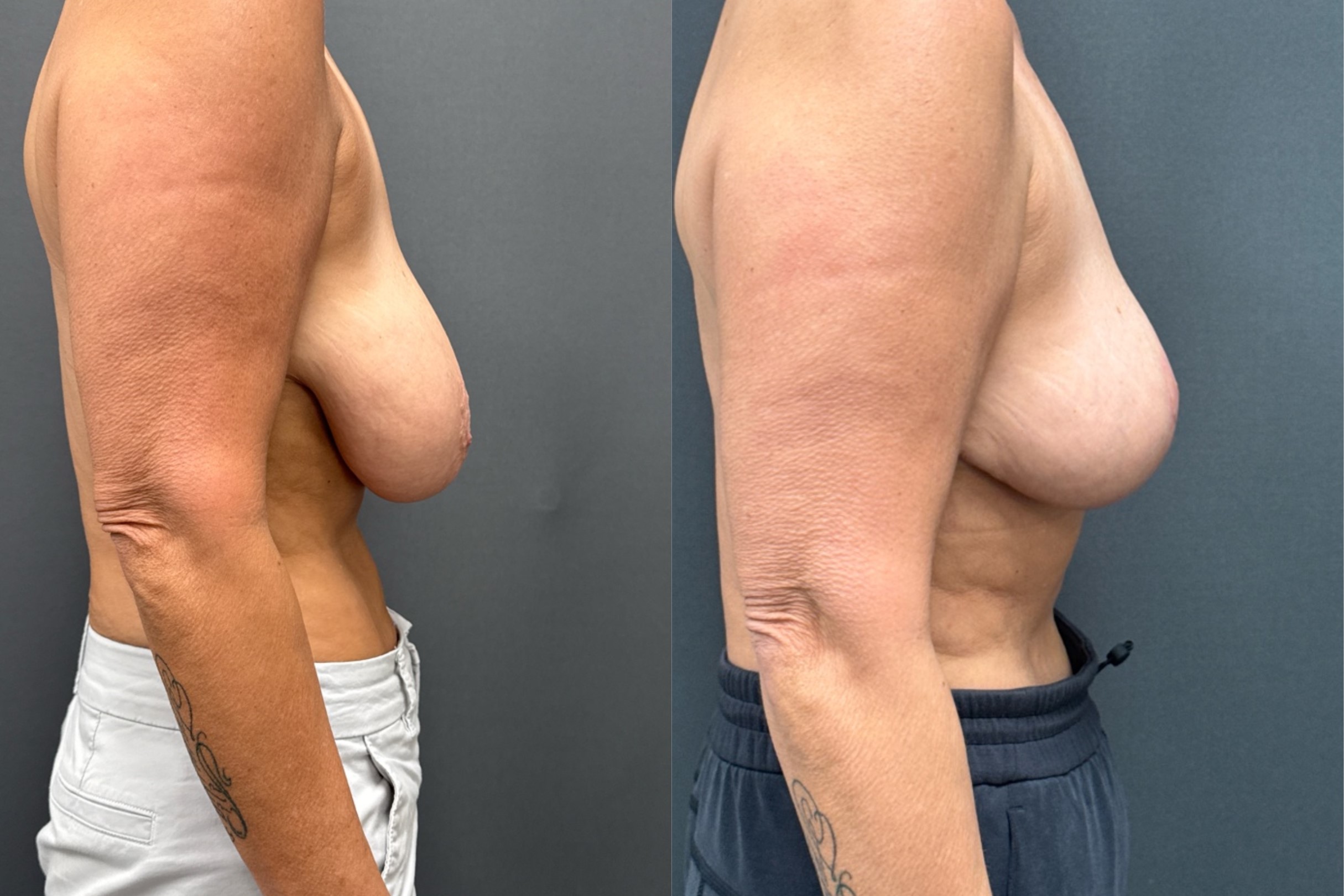 Before and After Image: Breast Reduction - right-side