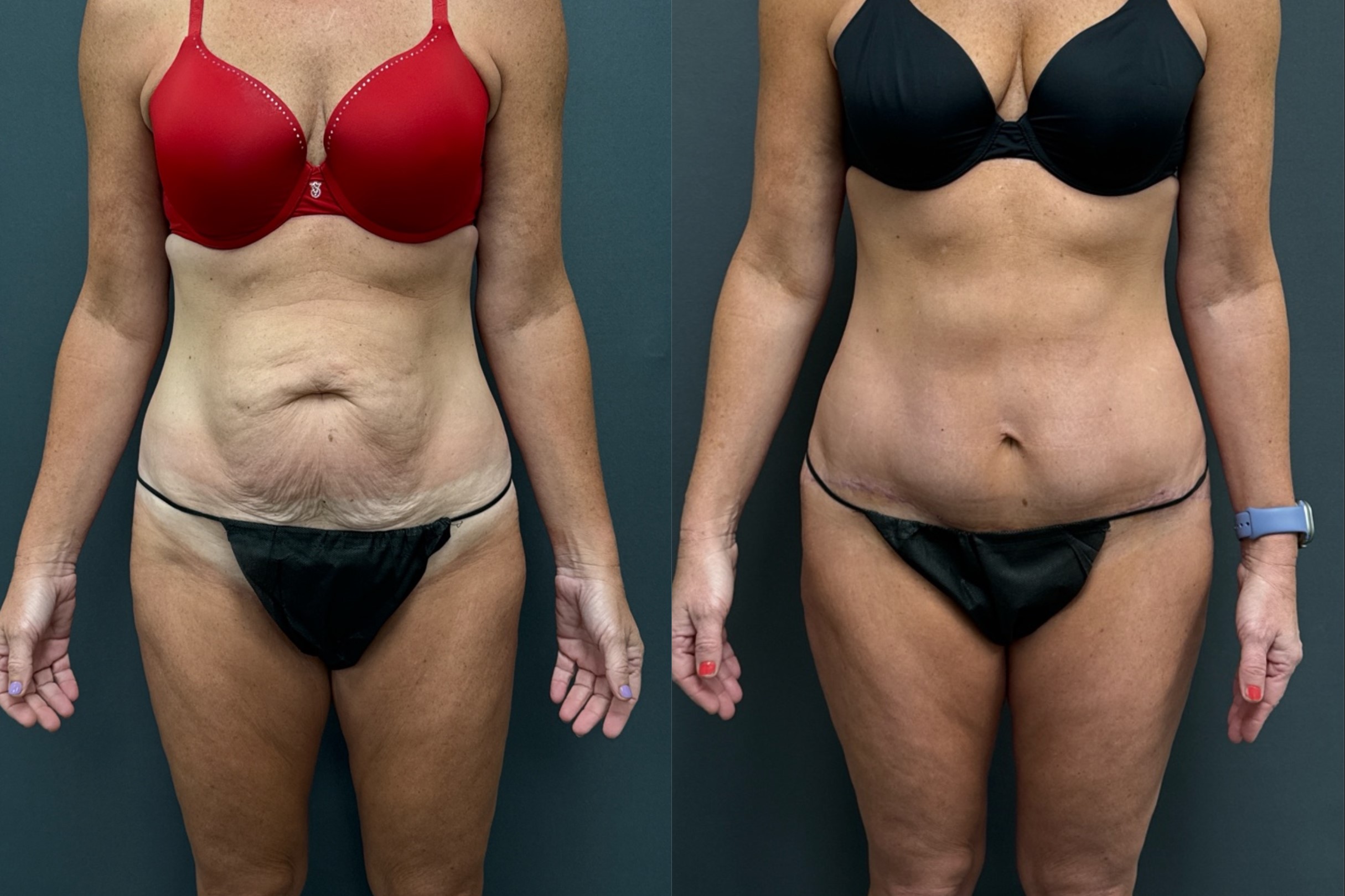 Before and After Image: Abdominoplasty