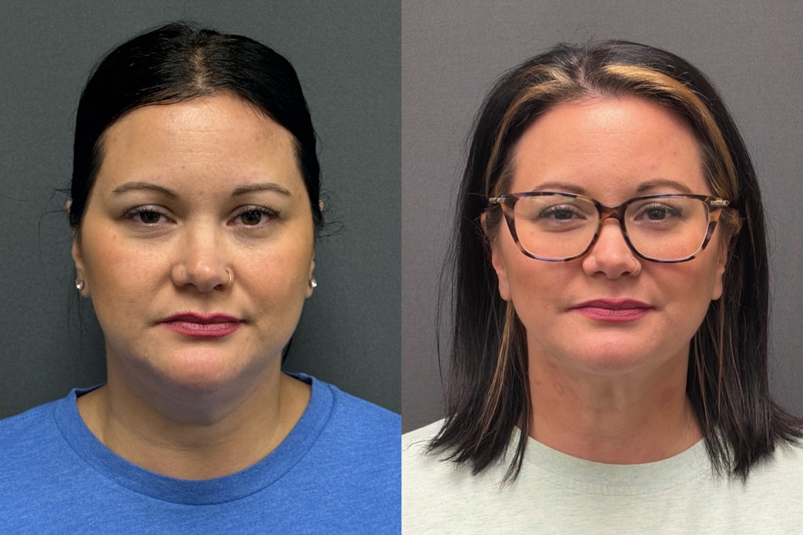 Before and After Image: Facetite - front