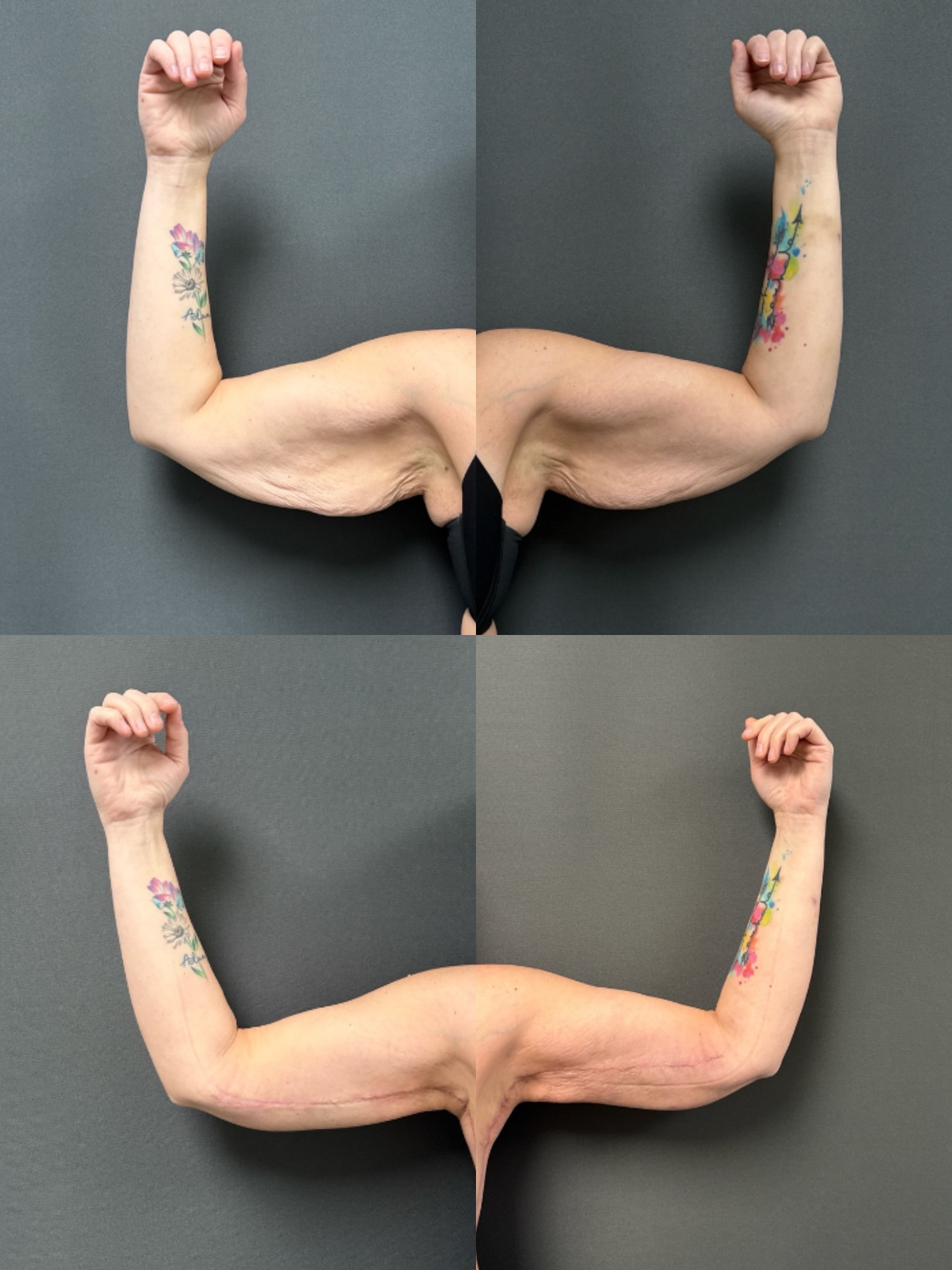Before and After Image: Brachioplasty - front