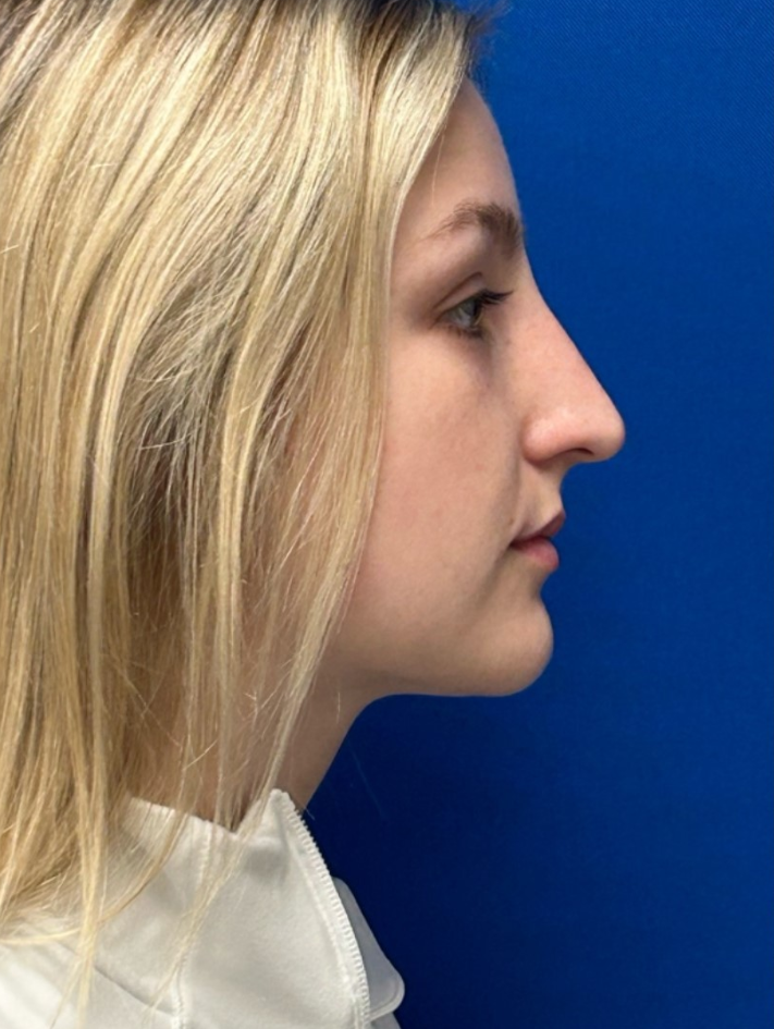 Before and After Image: Rhinoplasty - right-side