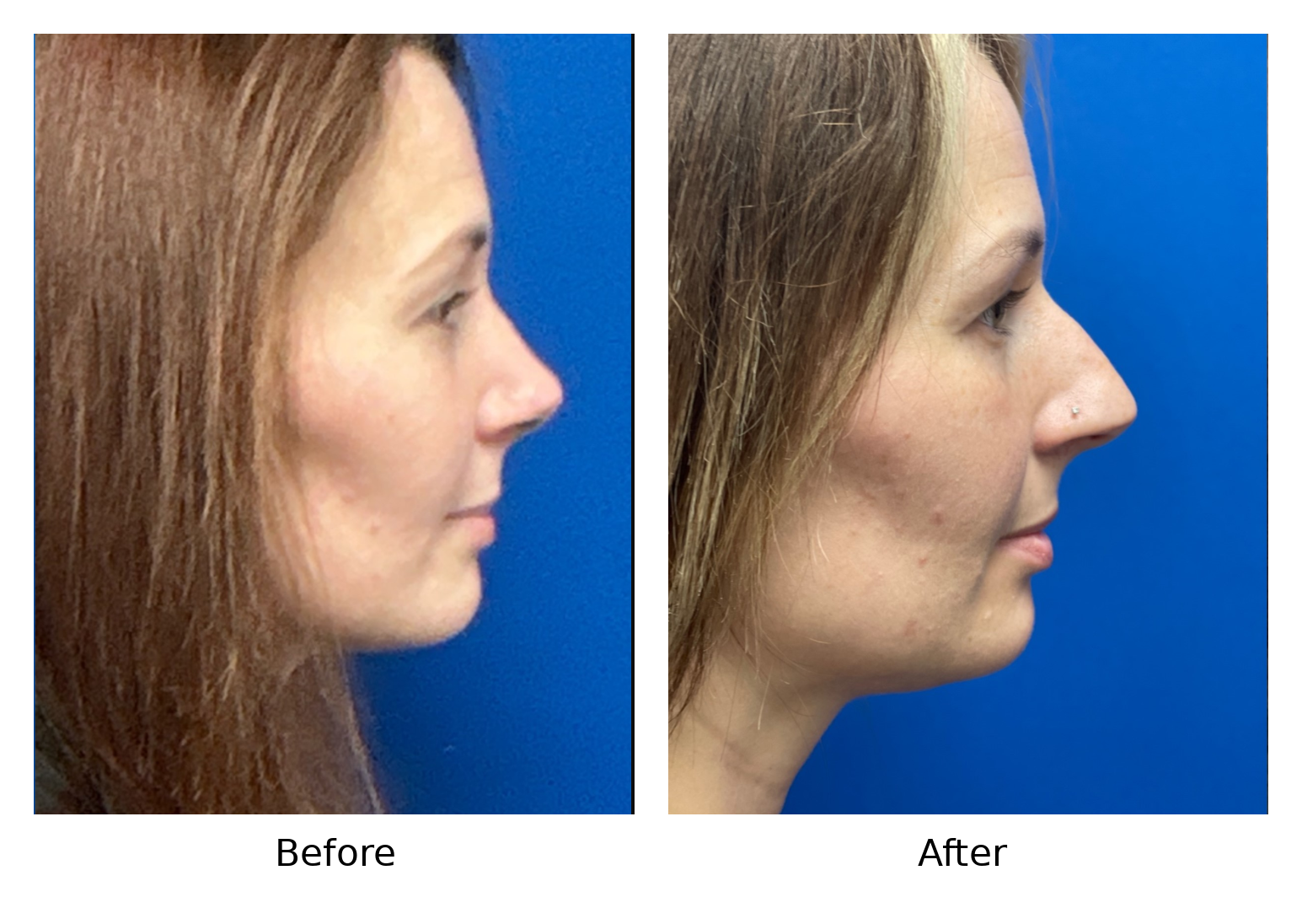 Before and After Image: Rhinoplasty - right-side