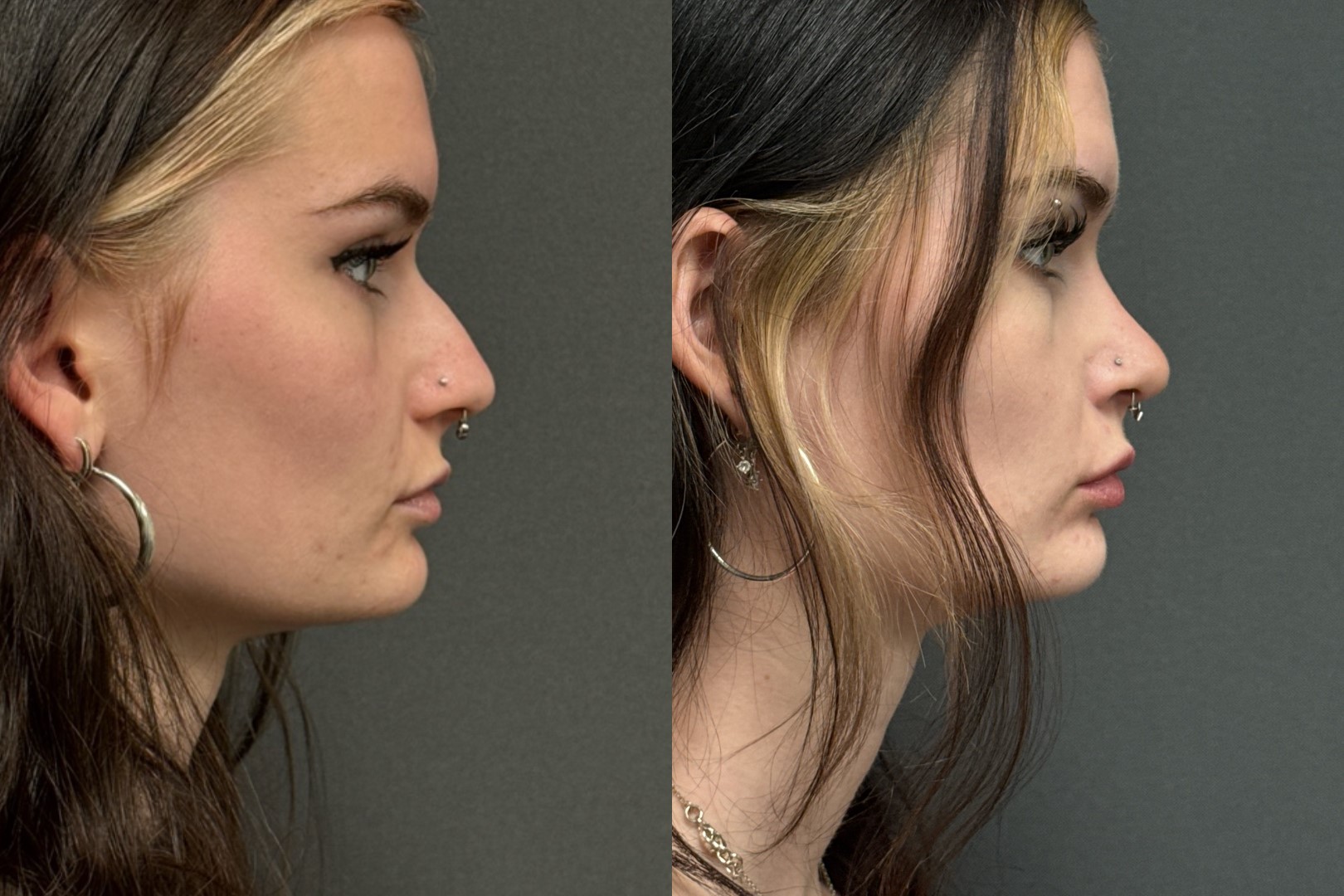 Before and After Image: Rhinoplasty