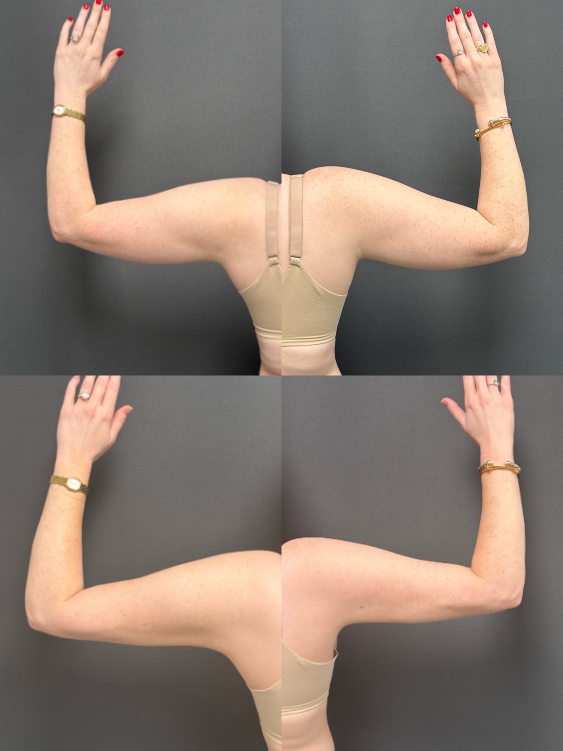 Before and After Image: Bodytite Arms