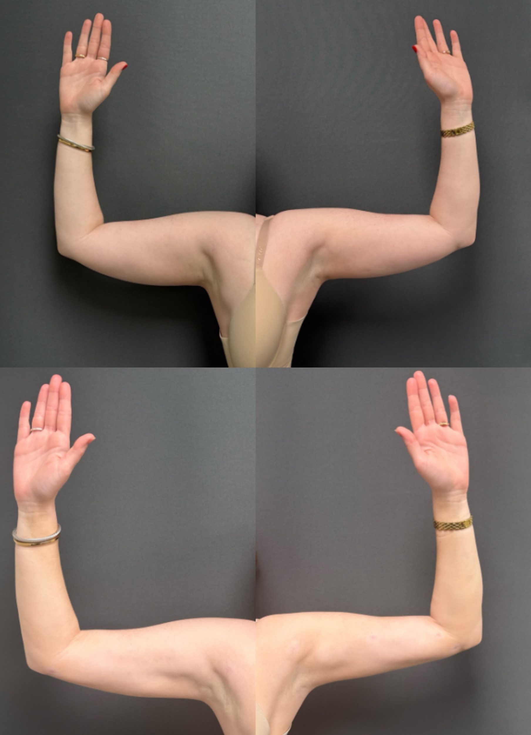 Before and After Image: Bodytite Arms - front