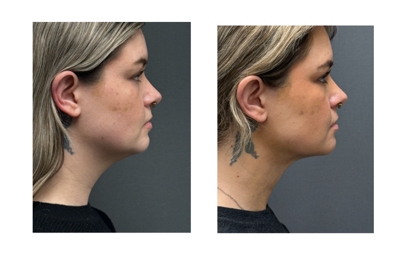 Before and After Image: FACEtite