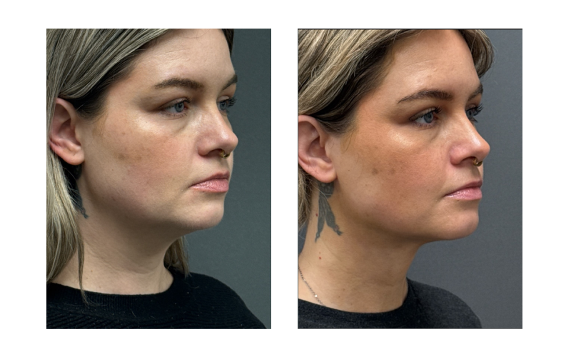 Before and After Image: FACEtite - right-front-oblique